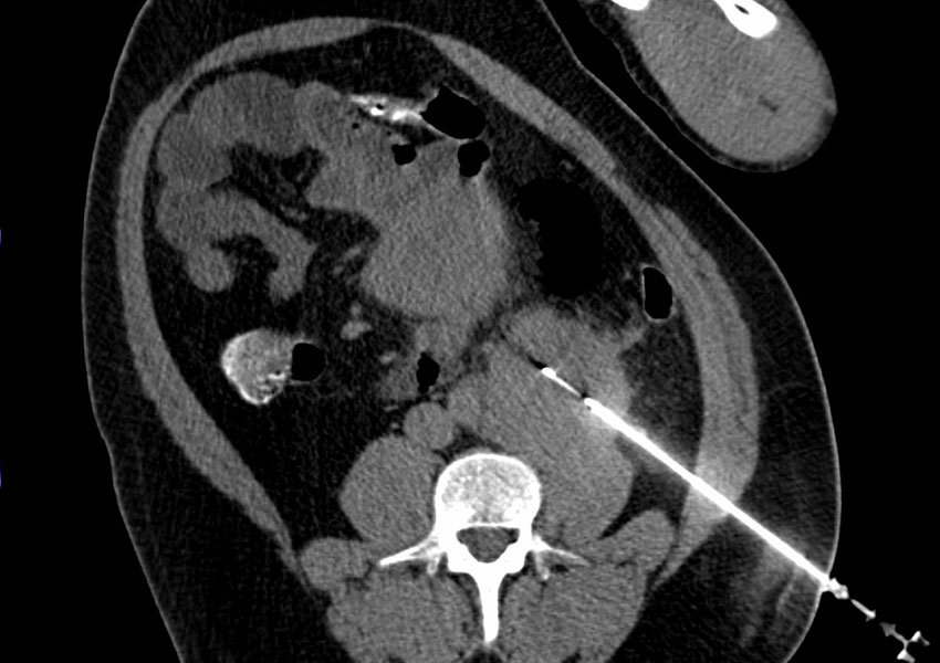 Biopsia Guiada Por Pet-ct