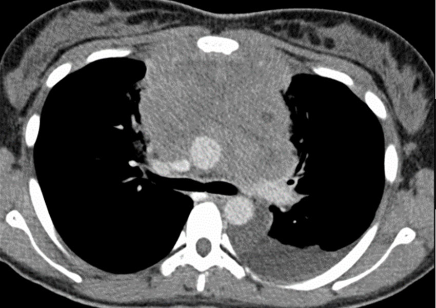 Biopsia de mediastino anterior