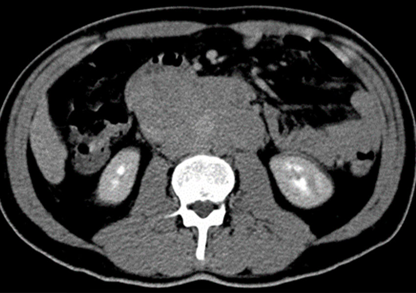 Biopsia de tumor retroperitoneal