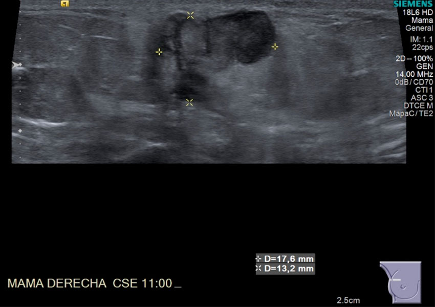 Crioablacion De Tumor En Mama Derecha 