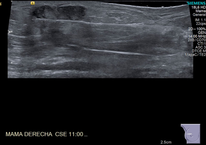 Crioablacion De Tumor En Mama Derecha