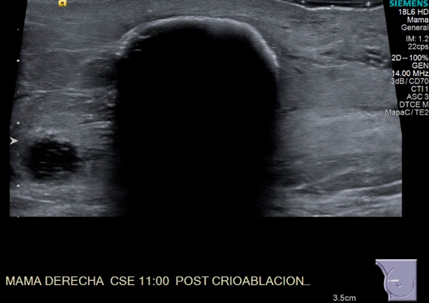 Crioablacion De Tumor En Mama Derecha