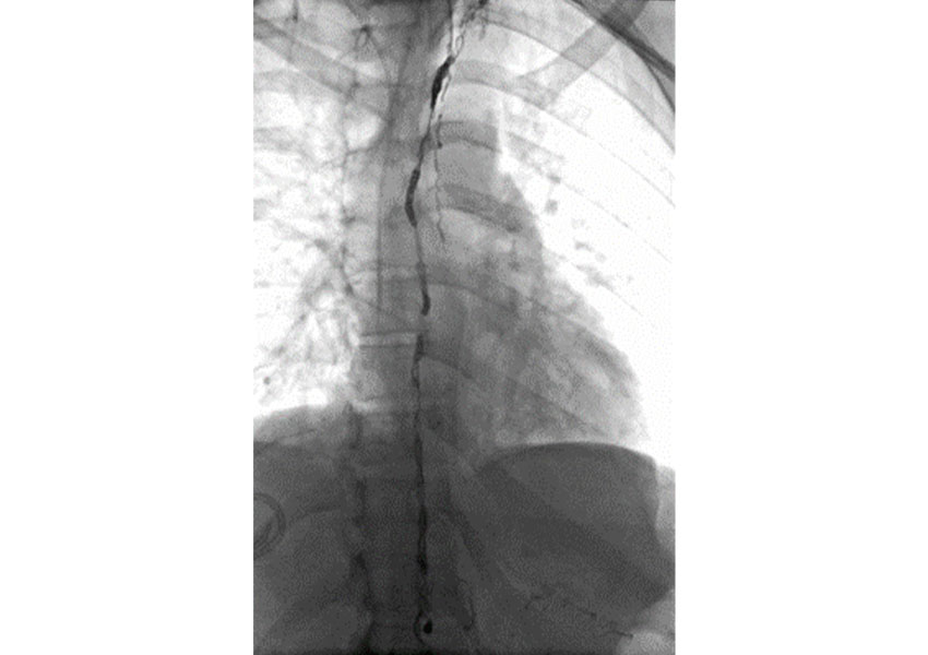 Embolización de conducto torácico