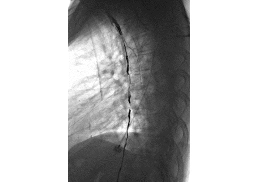 Embolización de conducto torácico