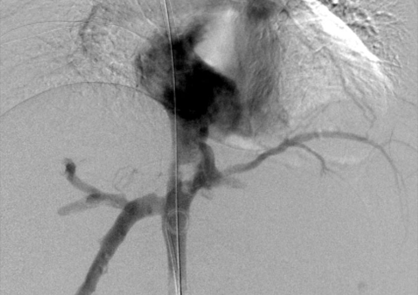 Estenosis Vena Cava Inferior