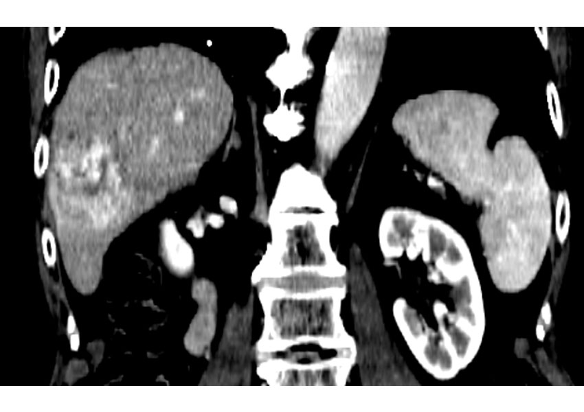 Quimioembolización hepática