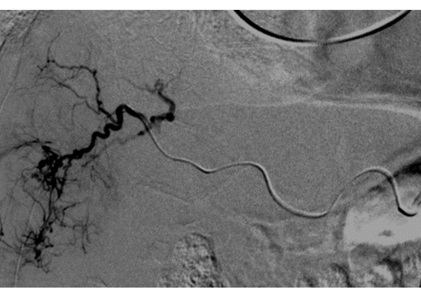 Quimioembolización hepática