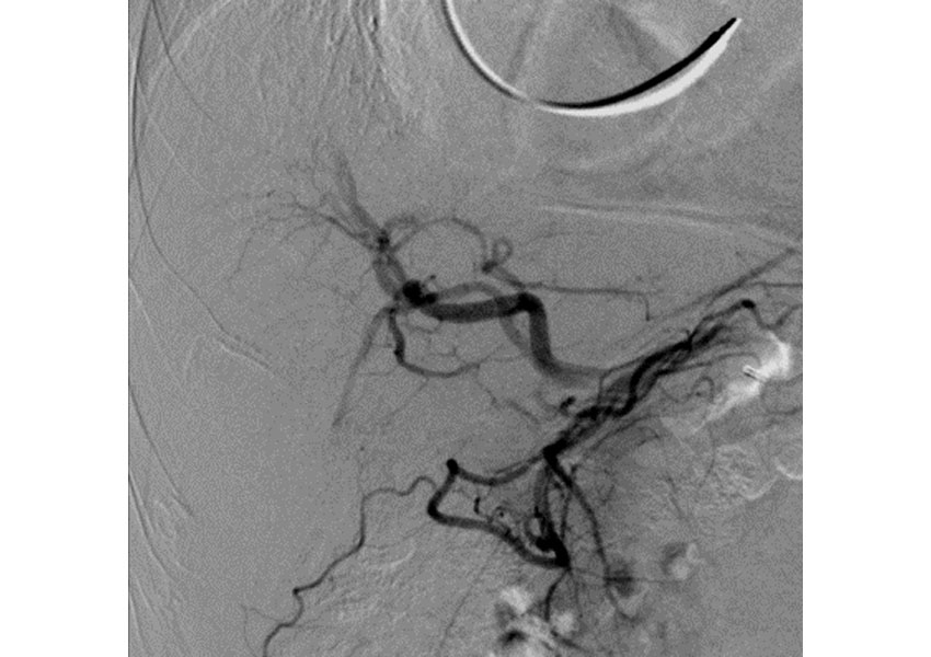 Quimioembolización hepática