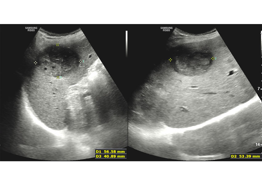 Quimioembolización hepática