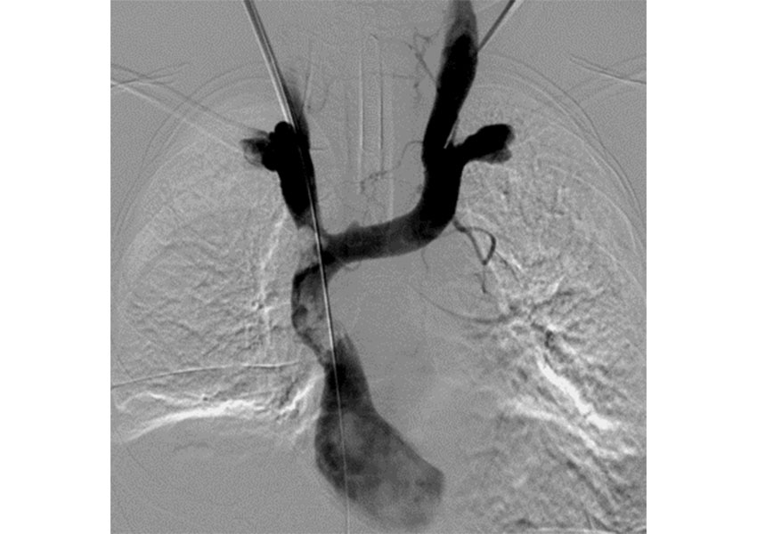 Síndrome de Vena Cava Superior