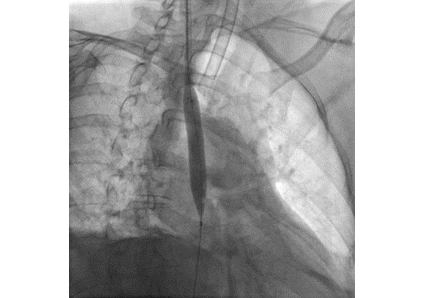 Síndrome de Vena Cava Superior