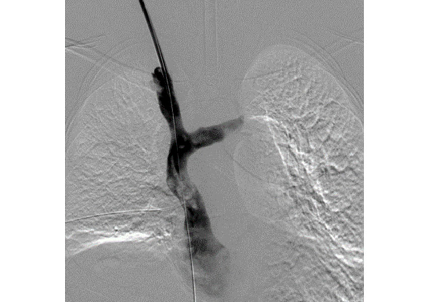 Síndrome de Vena Cava Superior