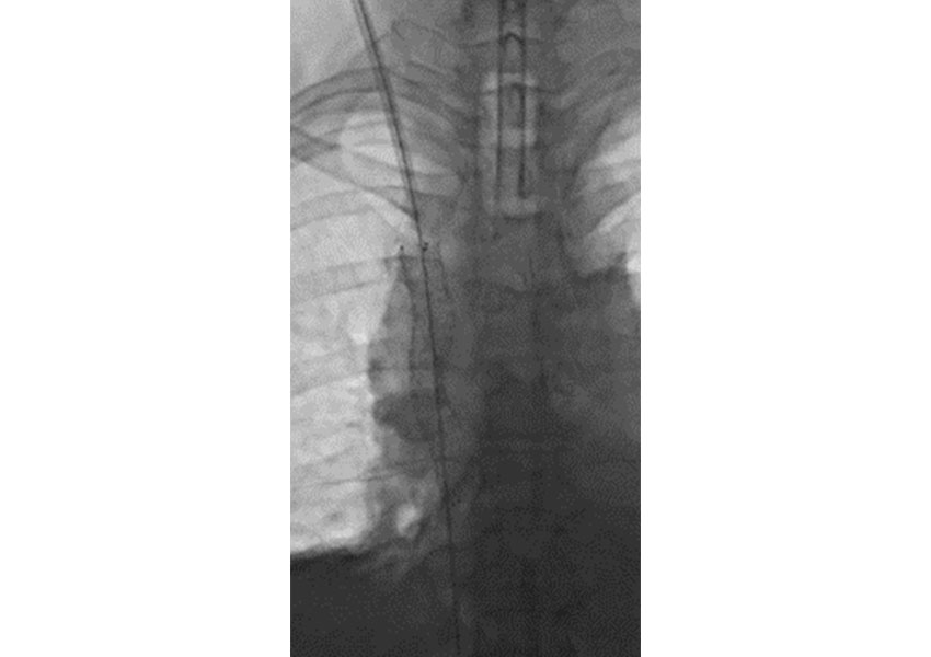 Síndrome de Vena Cava Superior