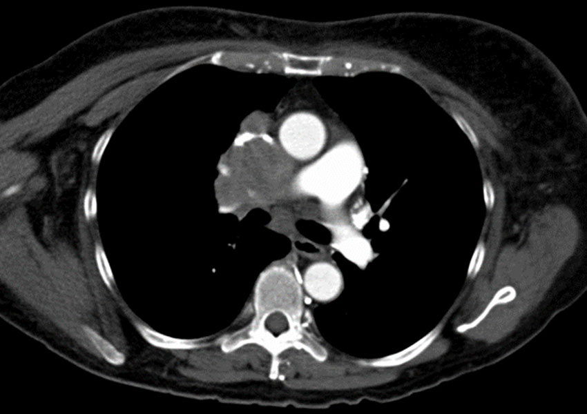 Síndrome de Vena Cava Superior