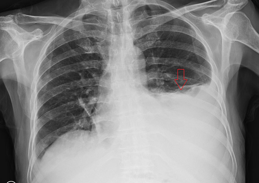 Toracocentesis evacuadora